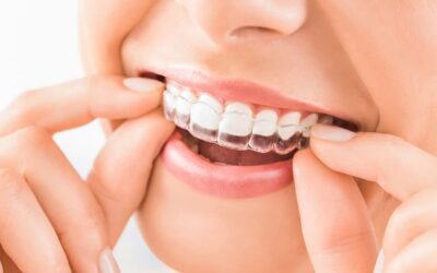 I vantaggi degli allineatori trasparenti INVISALIGN per il trattamento ortodontico nei pazienti adulti